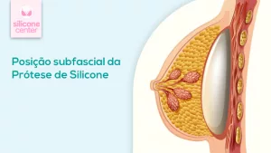 Por que ninguém fala do silicone na posição subfascial? Desvende os mitos e descubra toda a verdade Desenho mostrando a posição da prótese de silicone dentro do seio