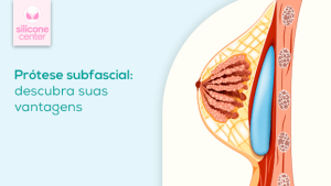 Silicone subfascial: você conhece as vantagens? Ilustração mostrando como a prótese de silicone fica atrás do músculo