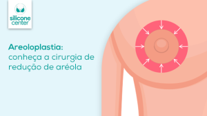 Areoloplastia: entenda a cirurgia que resolve o incômodo com as aréolas do seio Ilustração mostrando como é a cirurgia na aréola