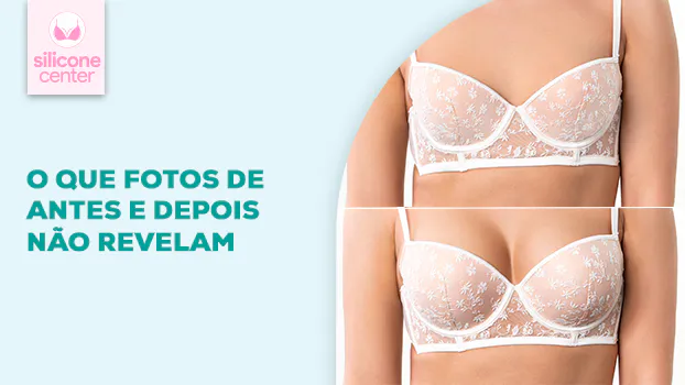 O que as fotos de antes e depois não mostram sobre a cirurgia de silicone?