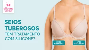 seios tuberosos e silicone