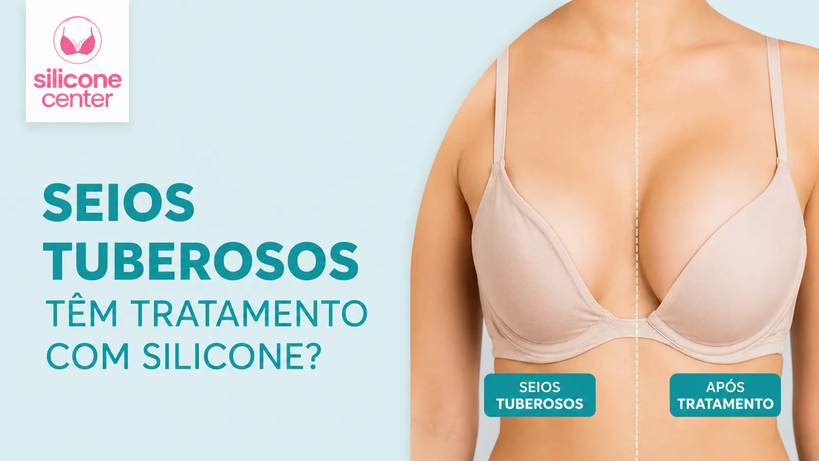 Quem tem seios tuberosos pode colocar silicone?