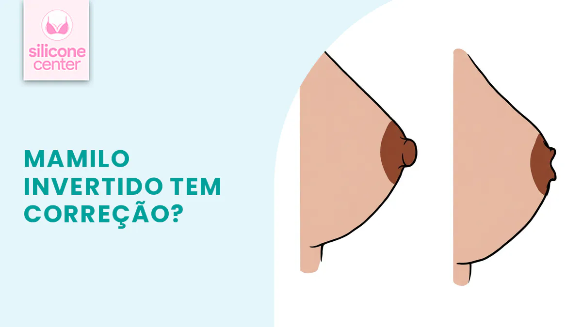 Mamilo invertido: é possível corrigir junto com a mamoplastia de aumento?